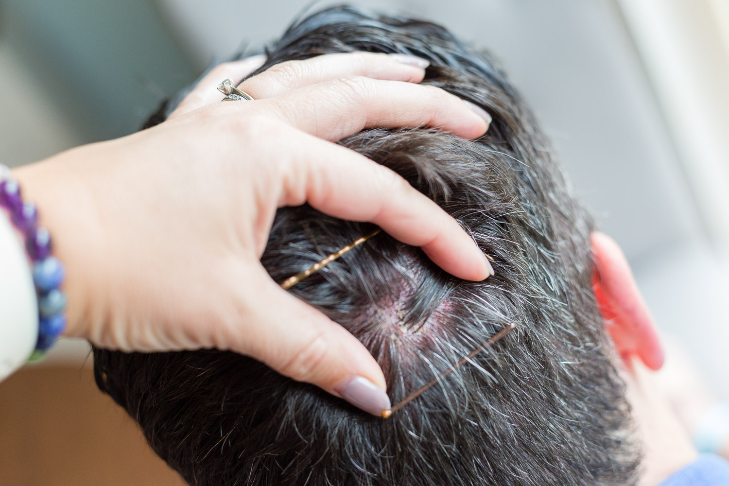 Nahaufnahme der Kopfhaut mit sichtbaren Lücken zwischen den Haaren bei kurzen Haaren.